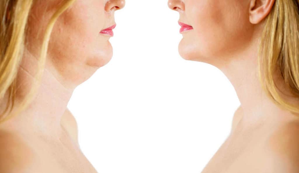 Double Chin treatment Hyde Park Corner before and after results