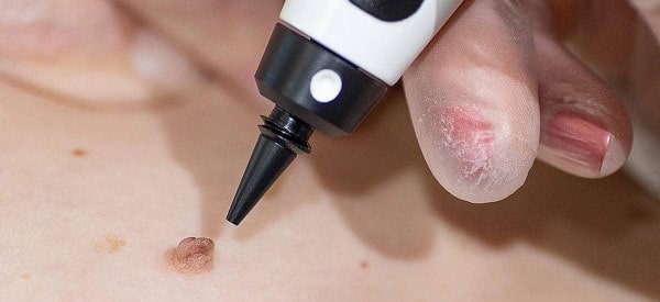 After Skin Tag Removal Hyde Park Corner