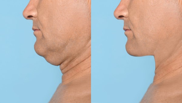 Which Non-Surgical Treatments Work Best for Jowls and Loose Skin Hyde Park Corner?