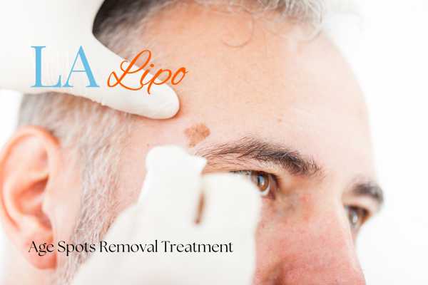 What Are the Most Effective Treatments for Age Spots Hyde Park Corner?