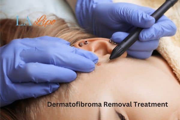 Dermatofibroma Removal Treatment Hyde Park Corner