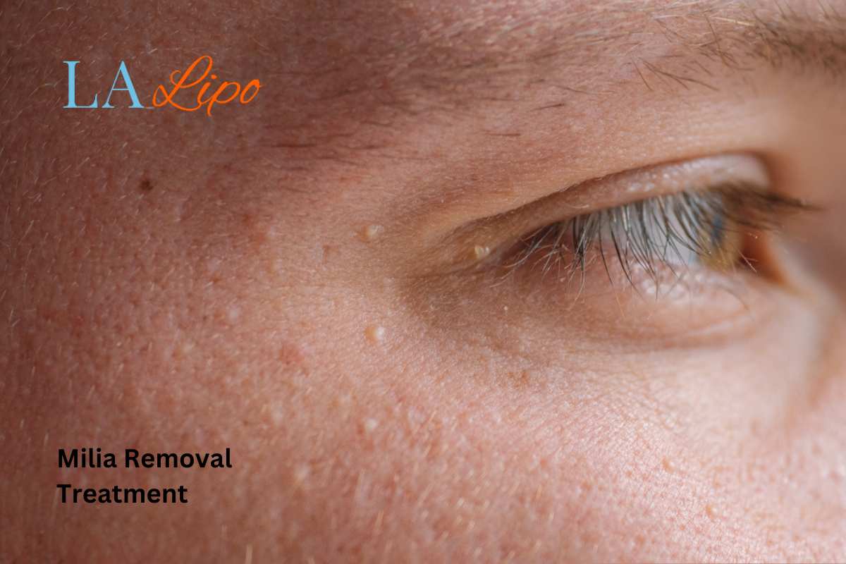 Cryopen Milia Removal: Is It the Easiest and Safest Option Hyde Park Corner?