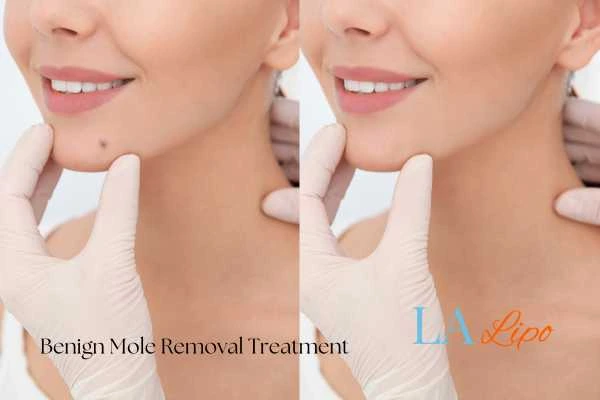 woman's before and after mole removal Hyde Park Corner results