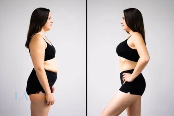 image of woman before and after results of LA-EMS Body Sculpting Hyde Park Corner to help treat Diastasis recti