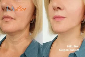hi-fu for wrinkles Hyde Park Corner before and after results
