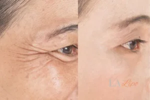 Before and after results of woman - HI-fu wrinkles reduction treatment Hyde Park Corner