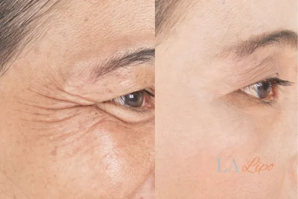 Before and after results of woman - HI-fu wrinkles reduction treatment Hyde Park Corner