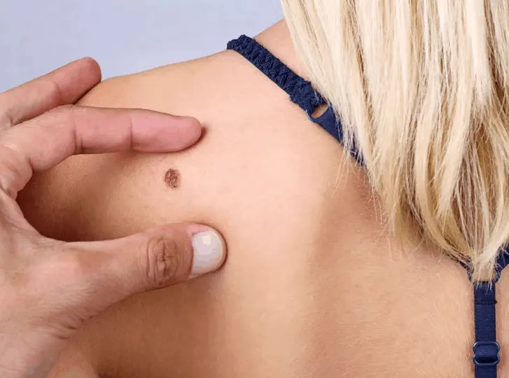 woman having mole removal Hyde Park Corner consultation before treatment.