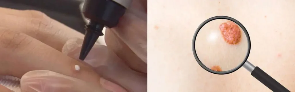 Cryopen for mole removal Hyde Park Corner - speak to our team today!