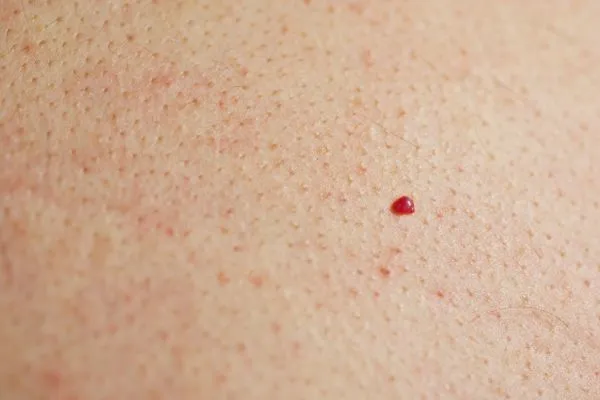 close up of a cherry angioma Hyde Park Corner