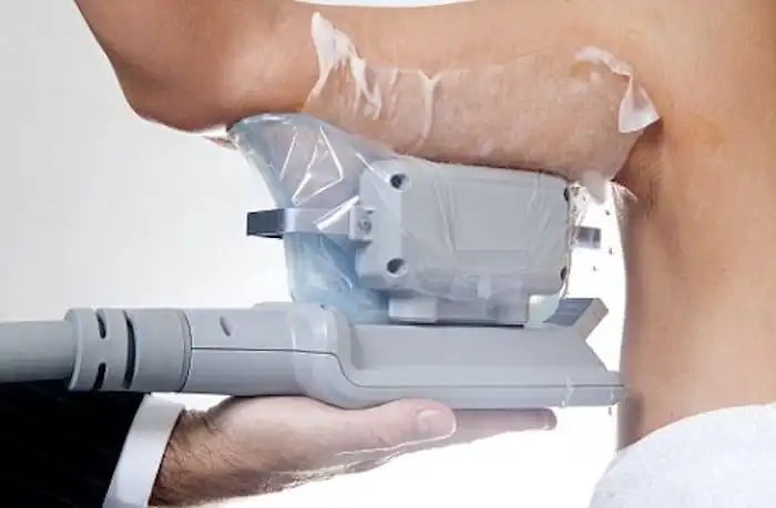 Picture of fat freezing Hyde Park Corner on the upper arms.