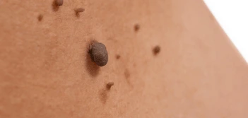 image of a skin tag Hyde Park Corner