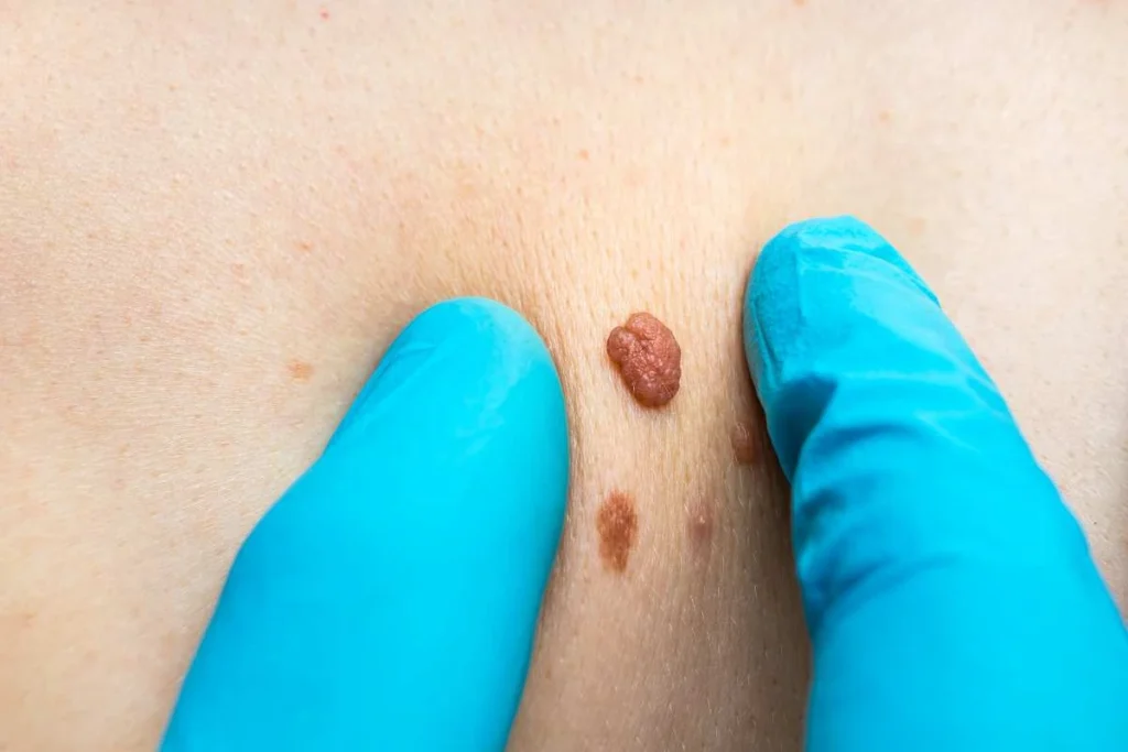 Consultant examining a skin tag Hyde Park Corner