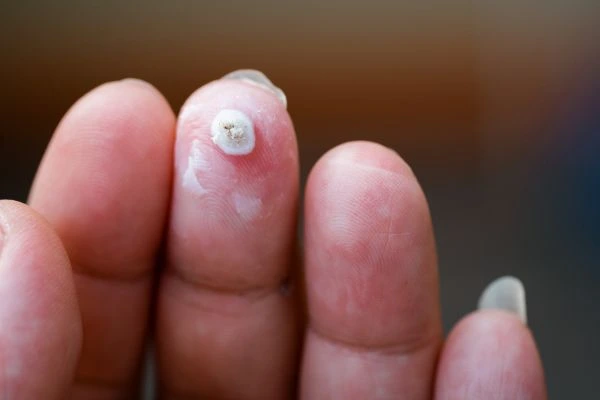 wart on person finger - cryotherapy to treat from LA LIPO Hyde Park Corner