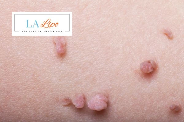 Does cryopen skin tag removal Hyde Park Corner hurt? Find out now call our team today!