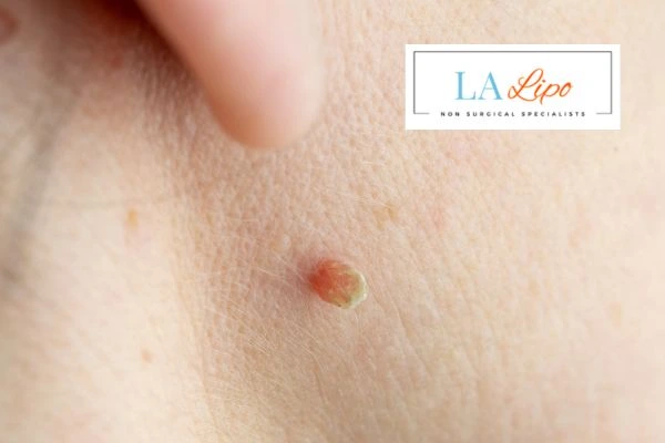 Book skin tag removal Hyde Park Corner today speak to our team now!