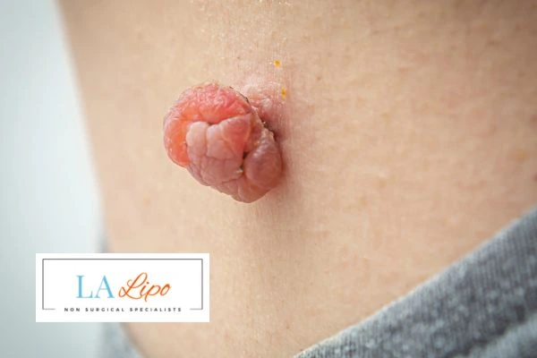 Interested in skin tag removal Hyde Park Corner? Concerned about the pain? Find out more today!