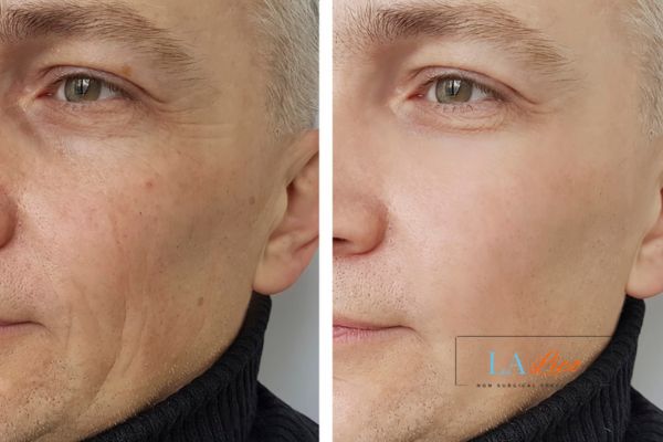 See the amazing results of Morpheus8 Treatment Hyde Park Corner!