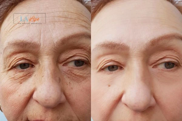 The powerful benefits of Morpheus8 Treatment Hyde Park Corner - Call Our team today!