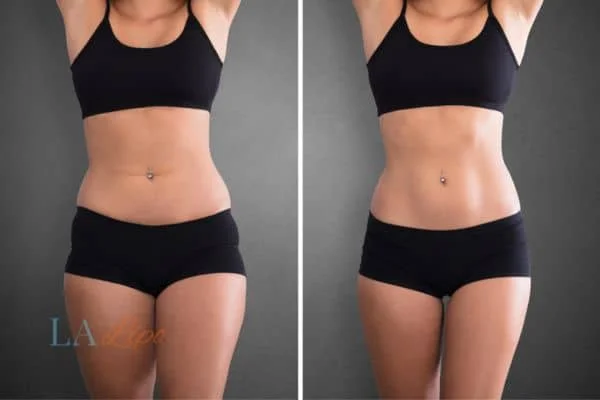 before and after results of non-surgical treatment to help a woman's body image and mental health Hyde Park Corner
