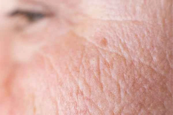 close up picture of a woman's face showing an age spot Hyde Park Corner