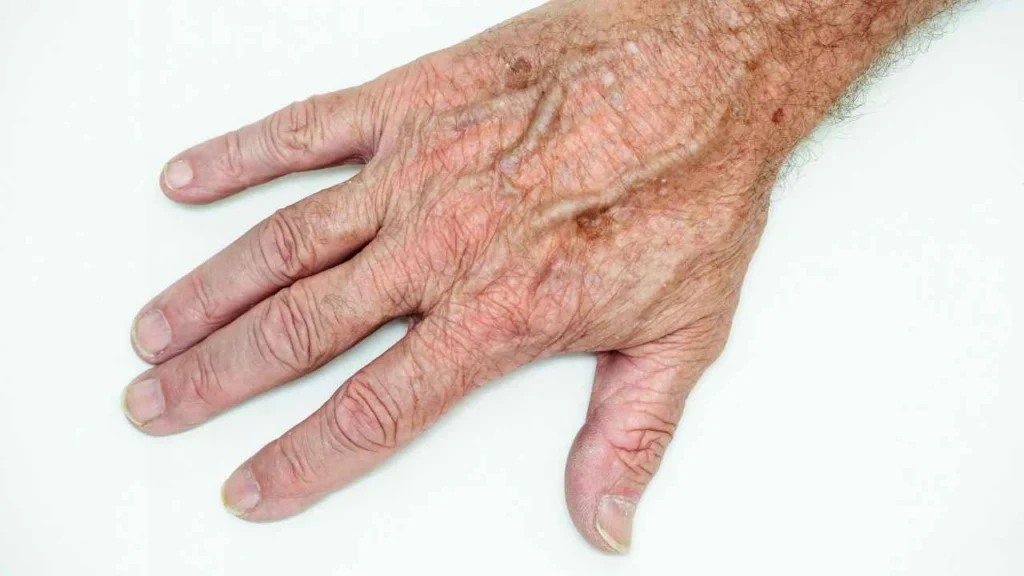 Male hand showing age spot Hyde Park Corner
