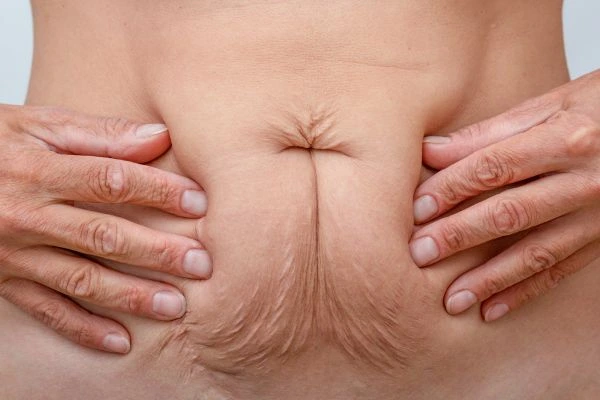 Should I Combine Diastasis Recti Treatment with Body Contouring for Better Results Hyde Park Corner?