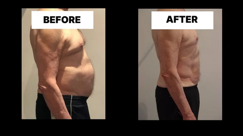 What Symptoms Can Diastasis Recti Cause in Men? Weak Core, Back Pain and Poor Posture Hyde Park Corner